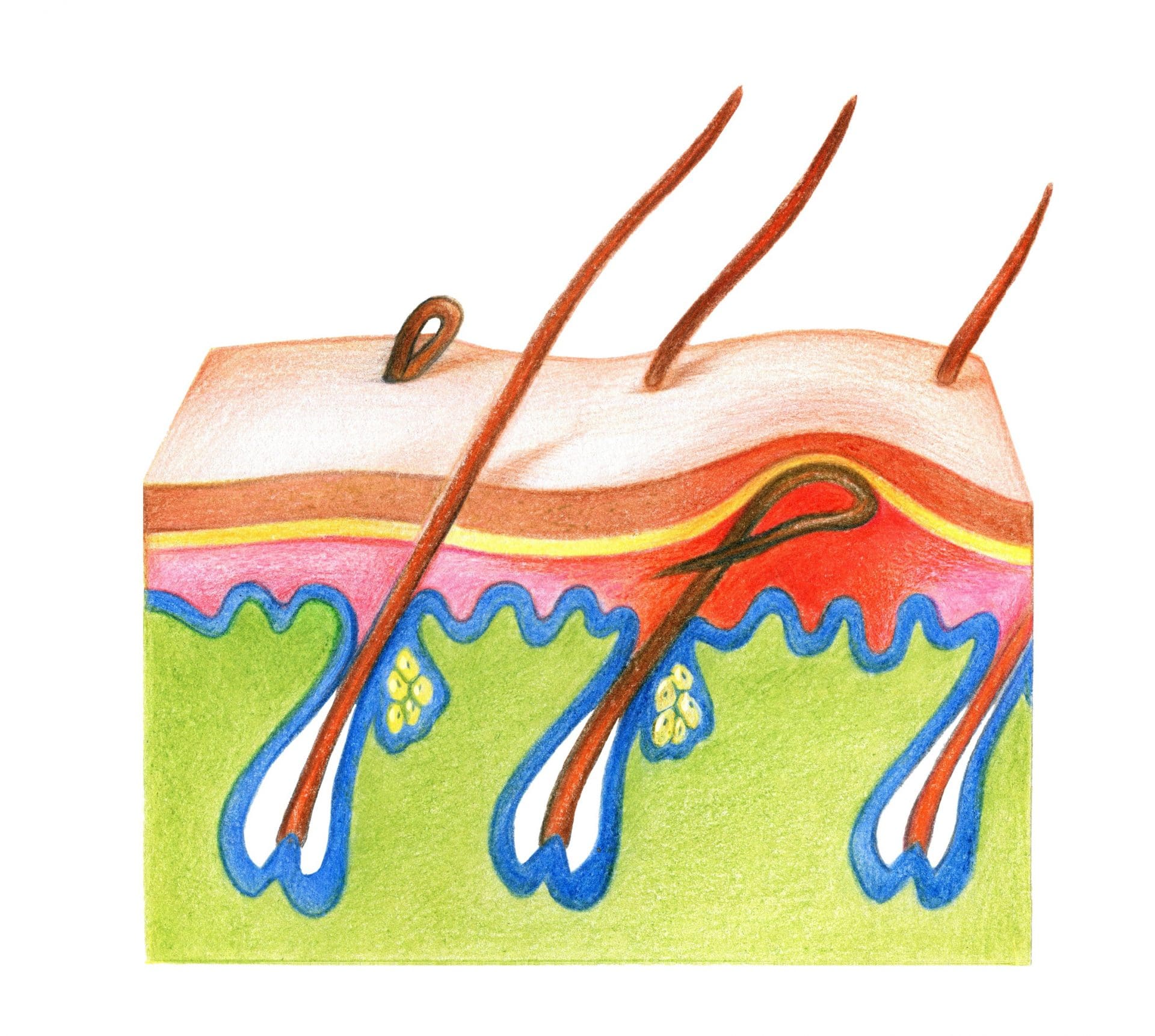 Illustration of an ingrown hair